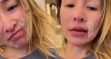 萧亚轩和男友被狗咬伤四个月后晒自拍视频 嘴角伤疤仍未痊愈