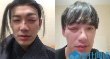 威廉拍戏出意外是怎么回事 意外怎么发生的现在情形如何