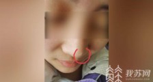 女子在南京侨台美容院隆鼻后留下凸起 卫监介入调查