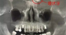男子额头长一颗牙 这竟是他得怪病的原因难以置信【热点】