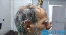 男子头部长出牛角 惊人故事背后令人匪夷所思